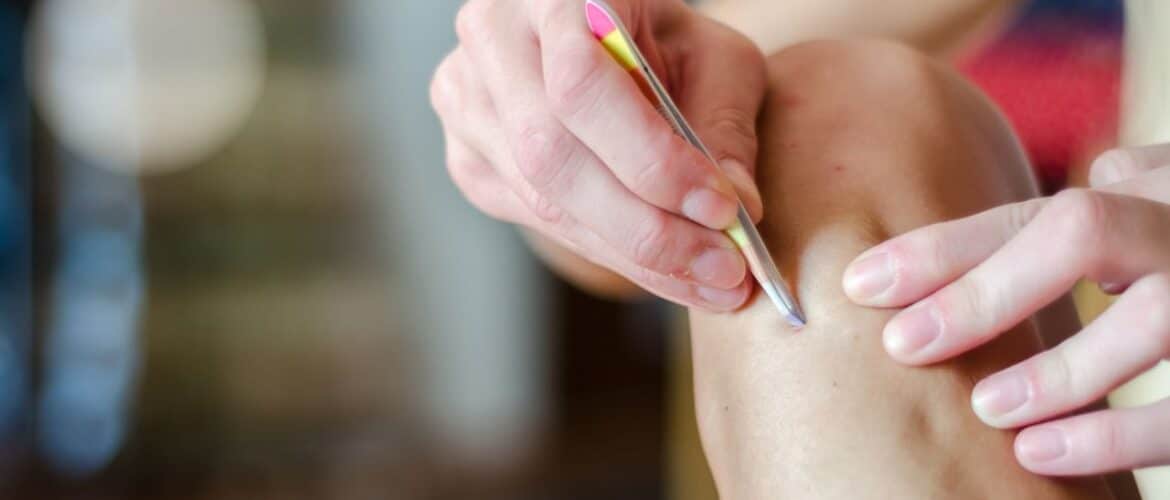 Can Brazilian Waxing Help With Ingrown Hairs